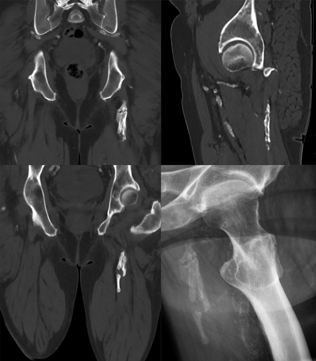 CT / radiograph. Heterotopic ossification within the hamstring (ischiocrural) musculature. Hellerhoff, CC BY-SA 4.0, via Wikimedia Commons.
