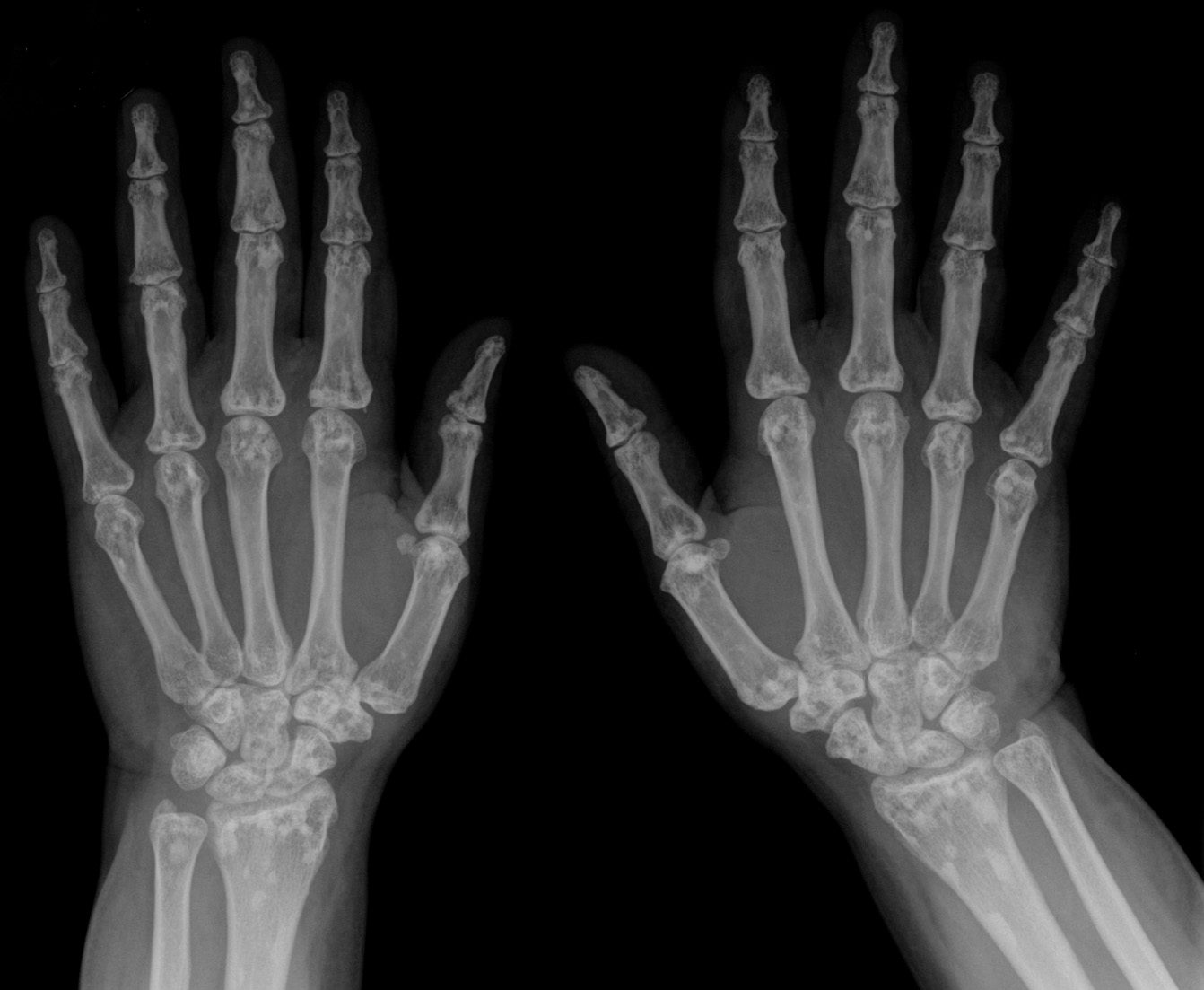 Radiograph. Multiple bone islands (enostoses) in osteopoikilosis - round sclerotic foci clustered in the carpus and epiphyses. Hellerhoff, CC BY-SA 3.0, via Wikimedia Commons.