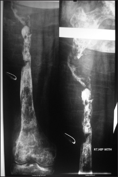 Radiograph. Gorham-Stout “vanishing bone” disease - progressive osteolysis of the femur. Baba et al., CC BY-NC-SA 3.0 (non-commercial), via PMC.