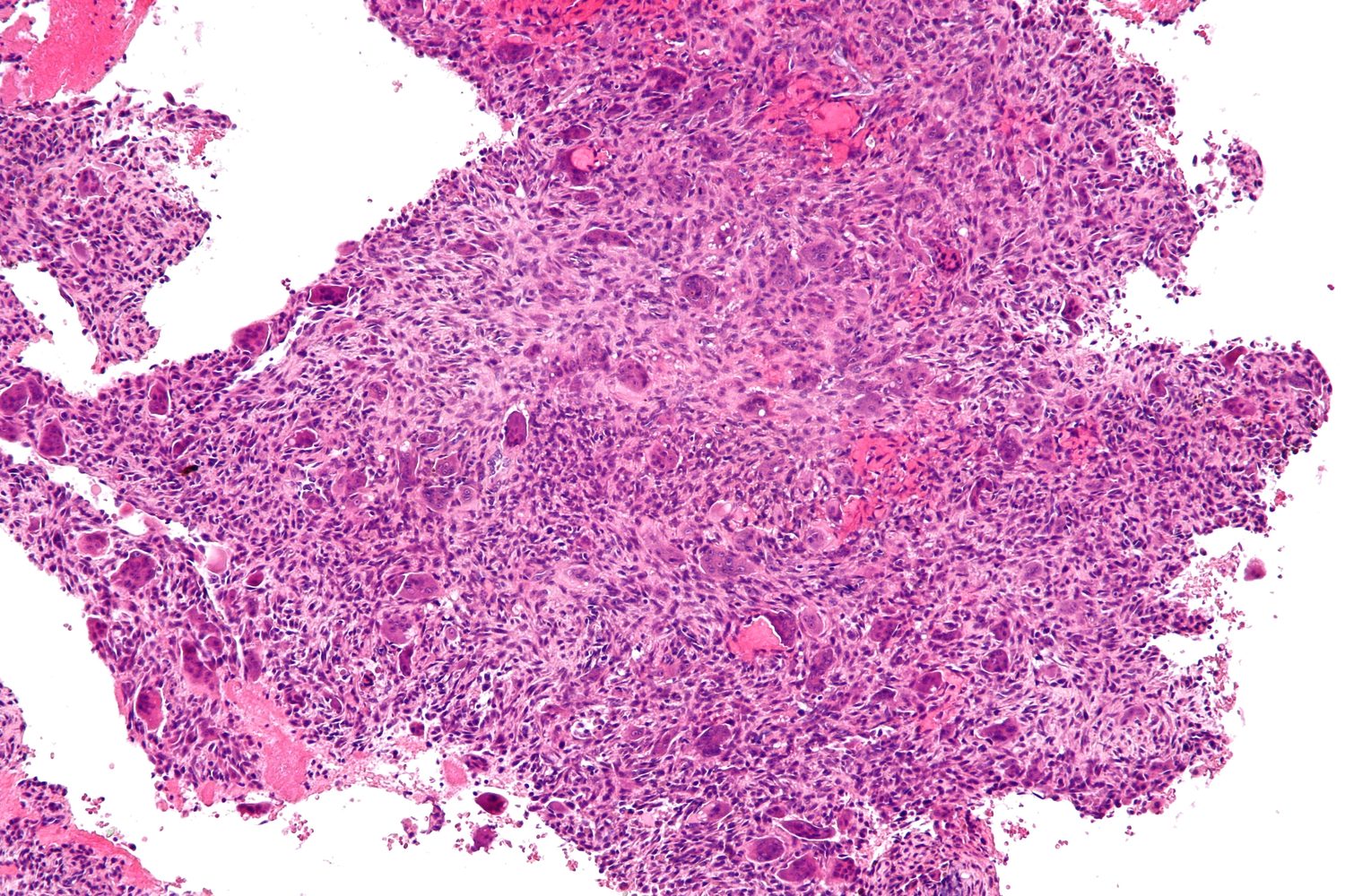 Histology. Aneurysmal bone cyst - osteoclast-type giant cells scattered through a fibrous spindle-cell stroma between blood-filled spaces that have no endothelial lining. Nephron, CC BY-SA 3.0, via Wikimedia Commons.