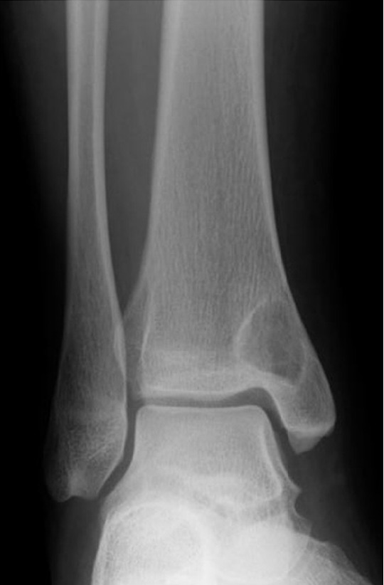 Radiograph. Intraosseous ganglion - a subchondral lytic lesion with a sclerotic margin in the distal tibia. Sakamoto et al., CC BY 3.0, via Wikimedia Commons.