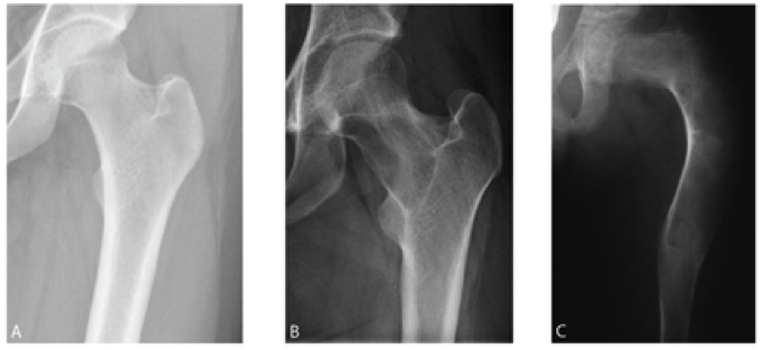 Radiograph. Fibrous dysplasia - hazy “ground-glass” matrix in the femoral neck. “Basmajoor”, CC BY-SA 4.0, via Wikimedia Commons.