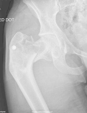 Radiograph. Fibrous dysplasia - shepherd’s-crook (varus) deformity of the proximal femur with a fatigue fracture. Al-Mouazzen et al., CC BY, via PMC.