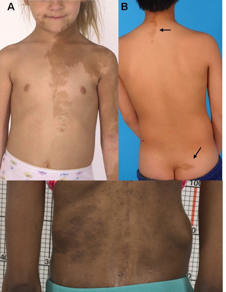 Clinical photograph. Café-au-lait macules of McCune-Albright syndrome with irregular “Coast of Maine” borders that respect the midline. Boyce & Collins (NIH), CC BY 2.0, via Wikimedia Commons.