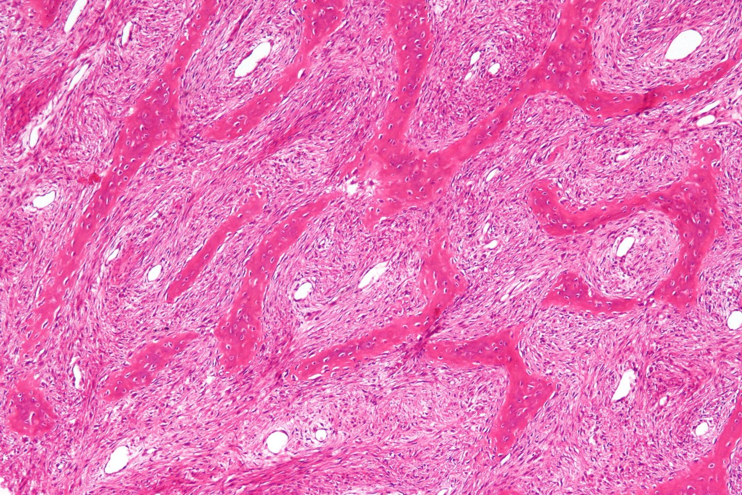 Histology. Fibrous dysplasia - curved “Chinese-letter” trabeculae of woven bone in a bland fibrous stroma, without osteoblastic rimming. Nephron, CC BY-SA 3.0, via Wikimedia Commons.