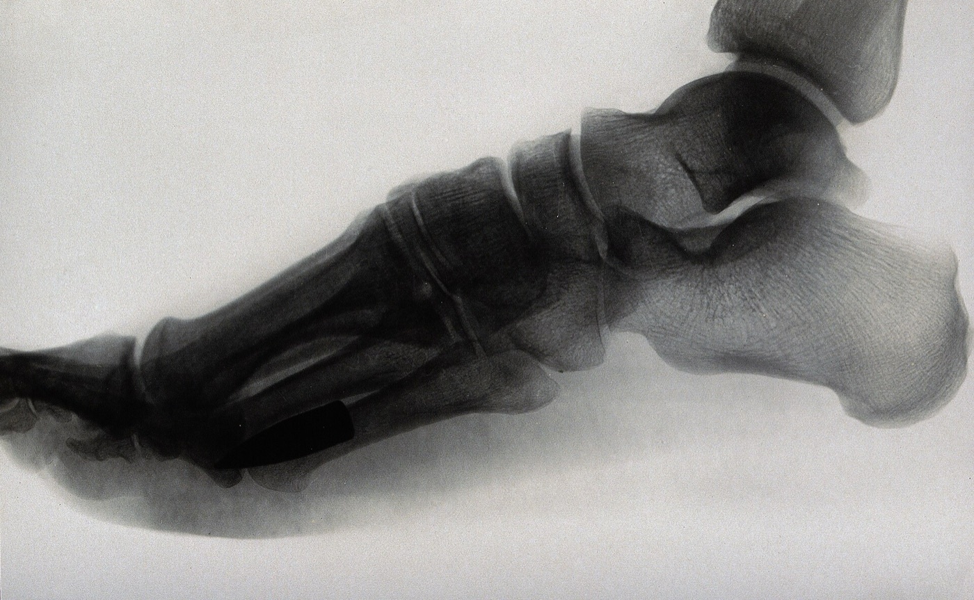 Figure 8. A retained bullet lodged plantar to the metatarsals on a lateral foot radiograph; an intra-articular retained bullet, by contrast, must be removed because of lead arthropathy. Source: Wellcome Collection, via Wikimedia Commons, CC BY 4.0.