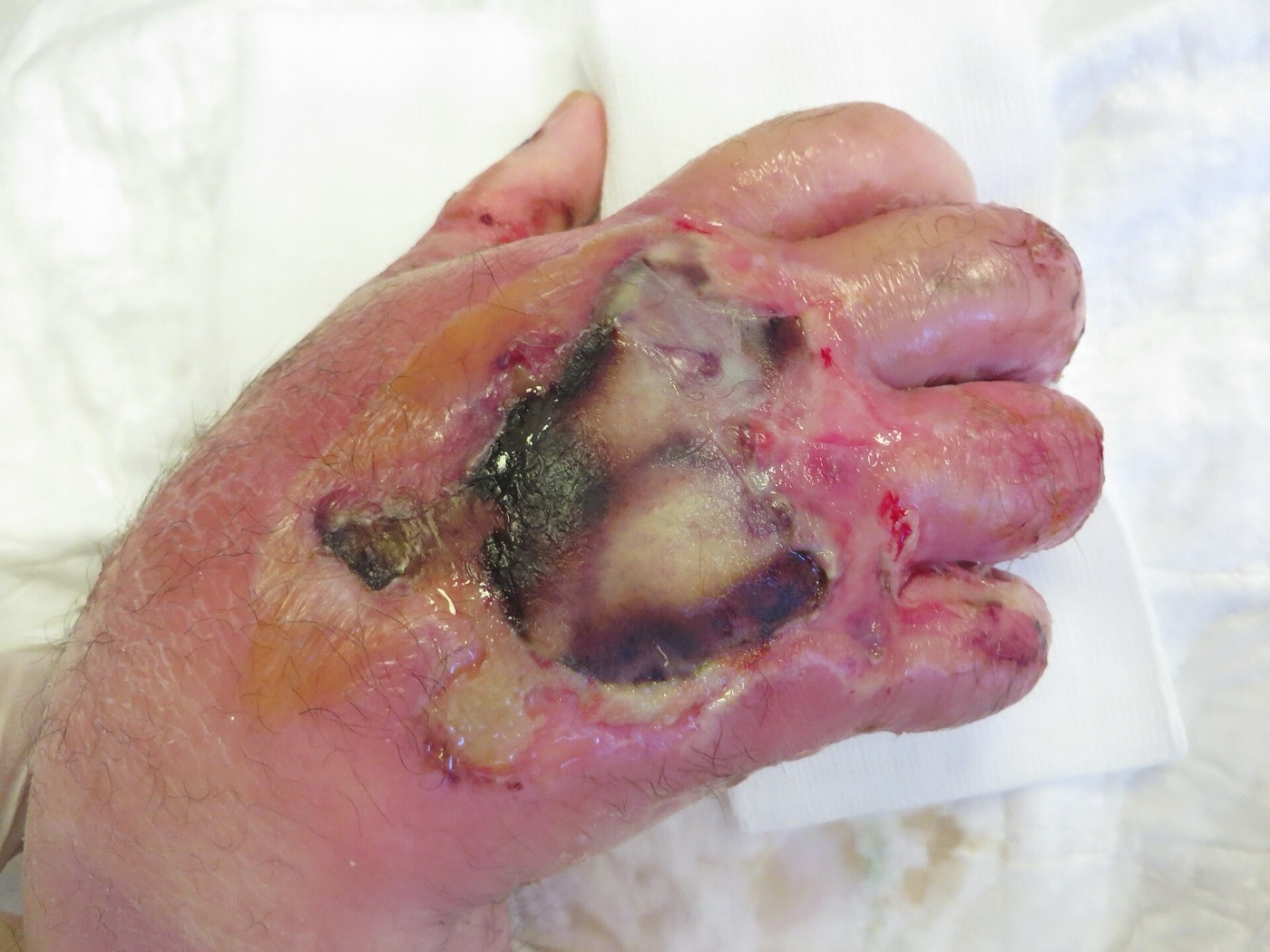 Figure 10. A crush injury of the hand, with necrosis and bullae. Source: AfroBrazilian, via Wikimedia Commons, CC BY-SA 4.0.
