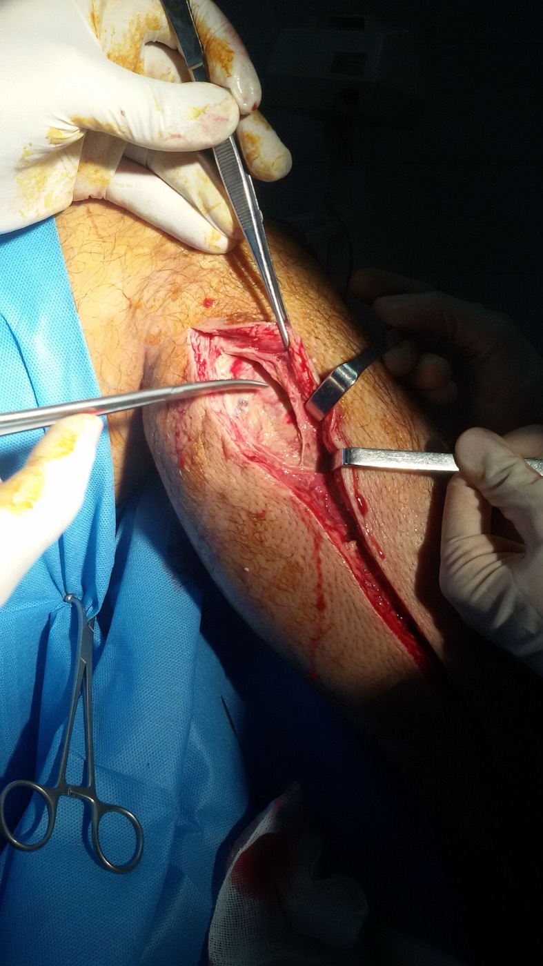 Figure 12. Fasciotomy of the leg for compartment syndrome, the fascial compartments laid open through a longitudinal incision. Source: Armin, via Wikimedia Commons, CC BY-SA 3.0.