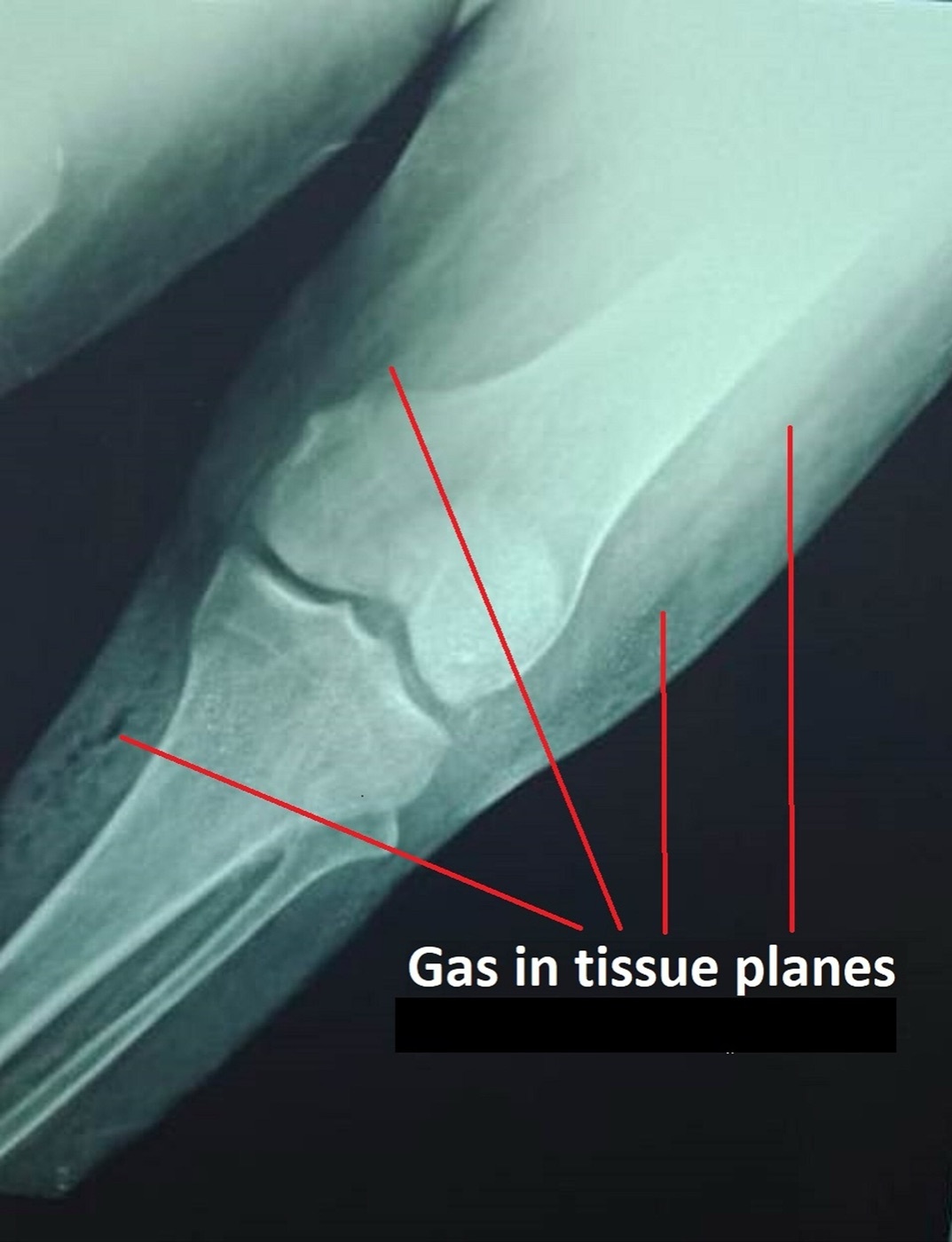 Figure 13. Gas gangrene of the leg: plain radiograph showing gas tracking through the tissue planes. Source: Shahab, via Wikimedia Commons, CC BY-SA 4.0.