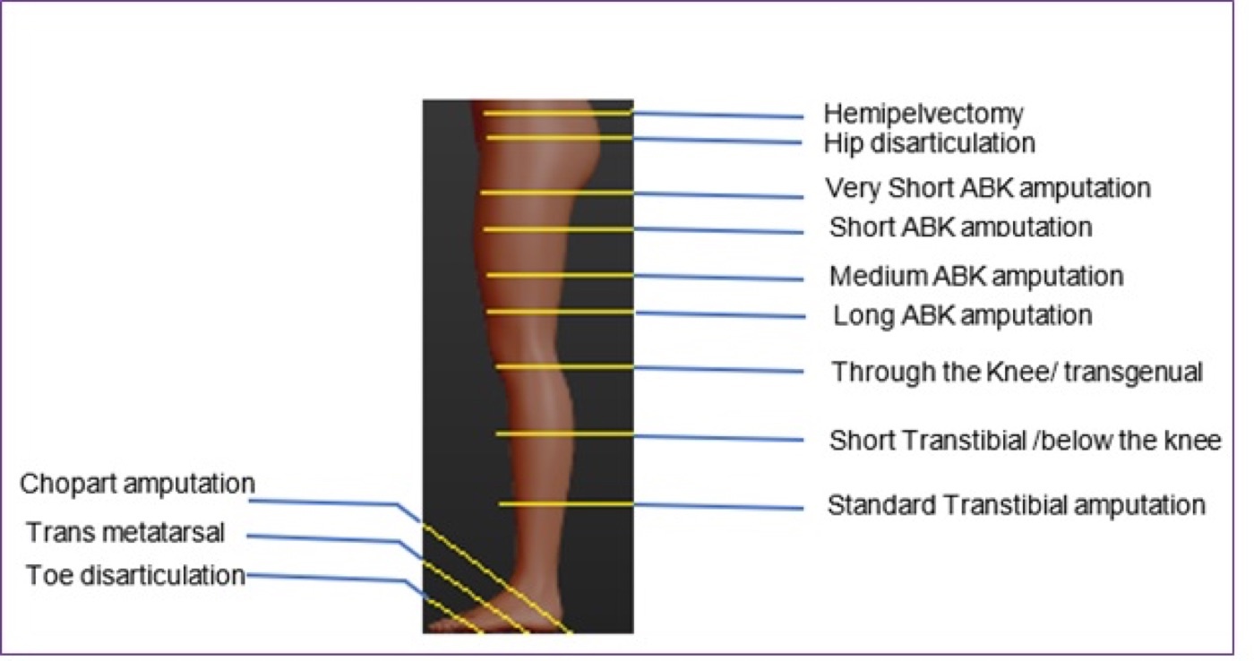 Figure 14. Levels of lower-limb amputation, from hemipelvectomy and hip disarticulation through the transfemoral, through-knee and transtibial levels to the partial-foot (Chopart, transmetatarsal, toe) amputations. Source: Edwin Khundi, via Wikimedia Commons, CC BY-SA 4.0.