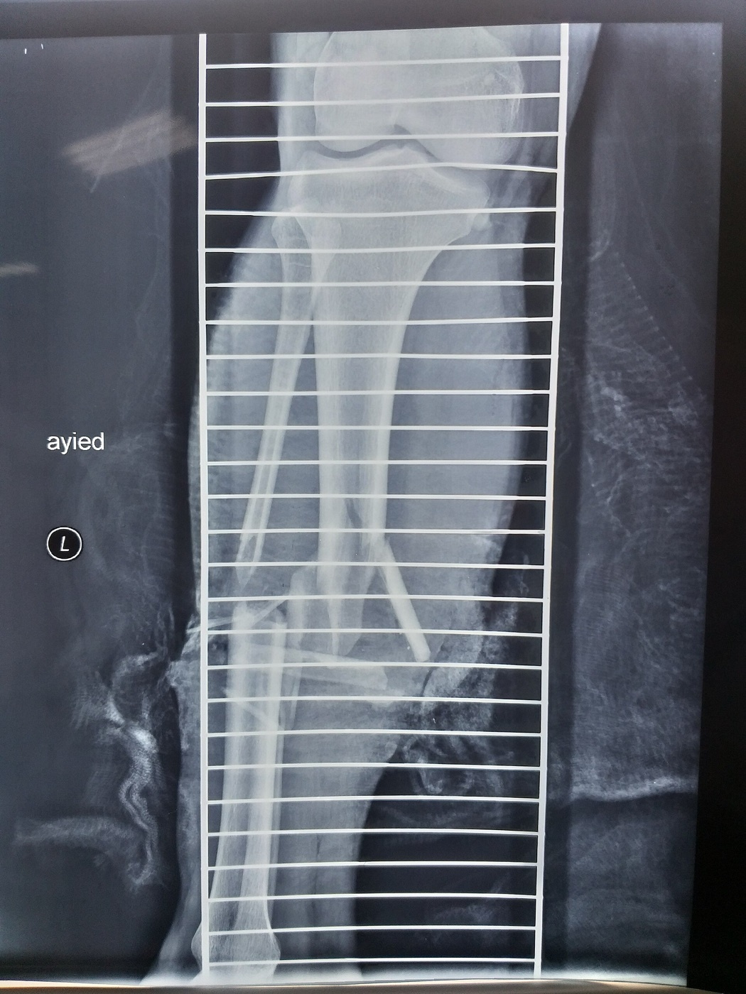 Figure 1. A displaced, comminuted open tibial and fibular shaft fracture. Source: MustafaSalahalden, via Wikimedia Commons, CC BY-SA 4.0.