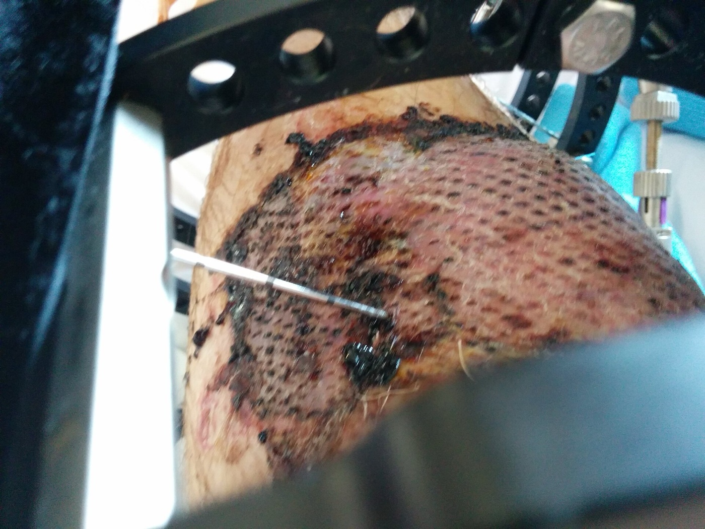 Figure 3. A lower-limb soft-tissue defect resurfaced with a meshed split-thickness skin graft over granulation tissue, a rung of the reconstructive ladder. Source: SOwhoisntme, via Wikimedia Commons, CC0 (public domain).