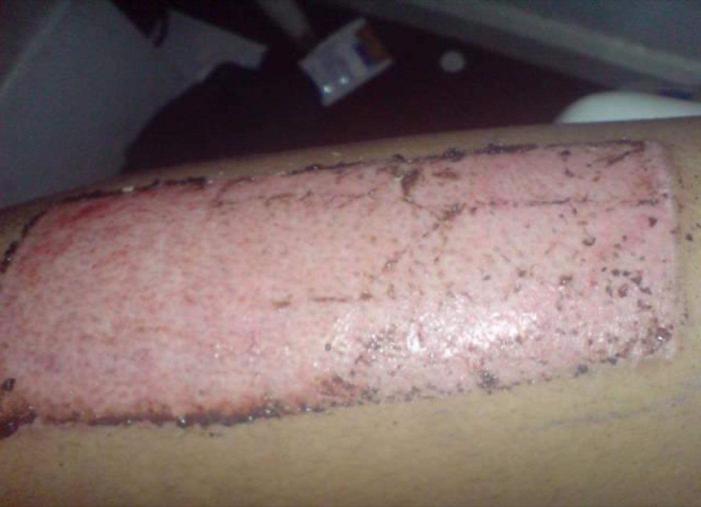 Figure 4. A split-thickness skin-graft donor site (thigh) healing by re-epithelialisation. Source: Kevin308, via Wikimedia Commons, public domain.