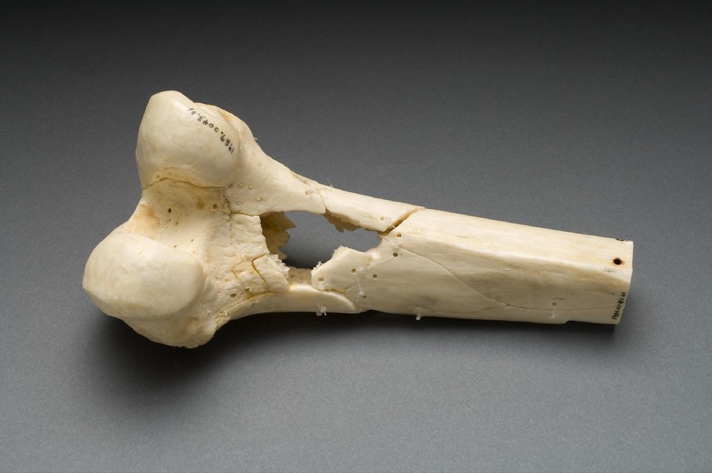 Figure 6. A dry human distal femur perforated by a low-velocity Minié ball: a relatively clean drill-hole defect from limited energy transfer. Source: National Institutes of Health (Ragsdale Gunshot Wound Study), via Wikimedia Commons, public domain (PD-USGov).
