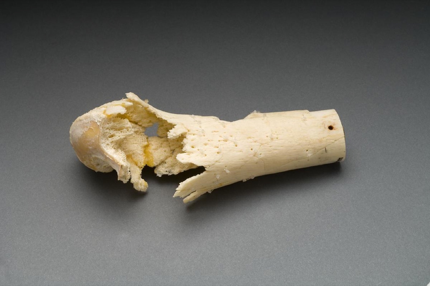 Figure 7. The same bone shattered by a high-velocity 5.56 mm M16 round: extensive comminution from high energy transfer and cavitation. Source: National Institutes of Health (Ragsdale Gunshot Wound Study), via Wikimedia Commons, public domain (PD-USGov).