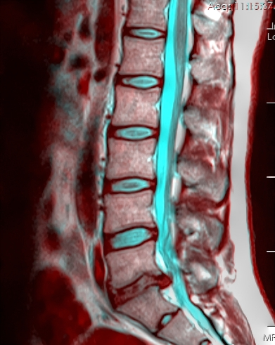 Лумбален гръбначен стълб на MRI