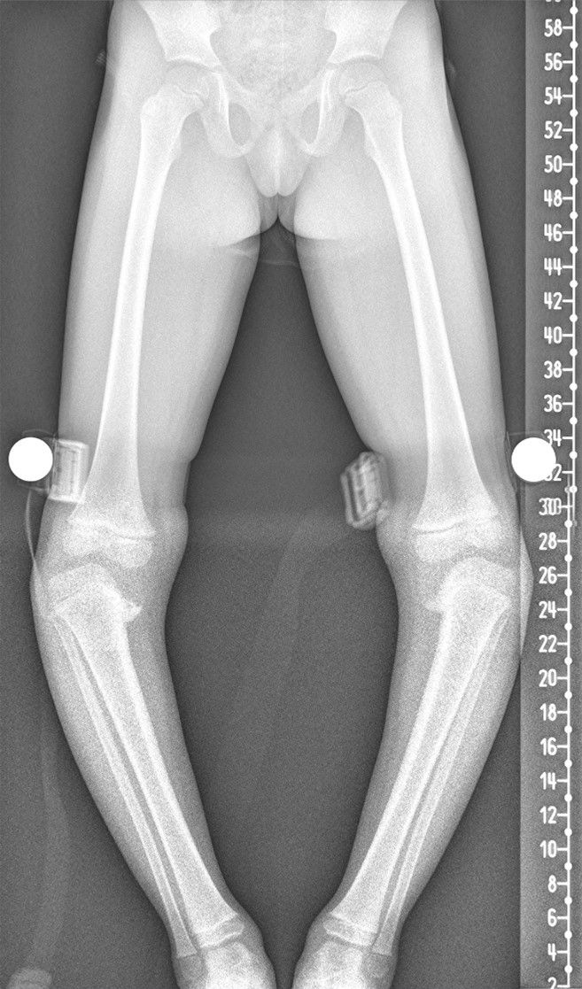 Болест на Blount, двустранна tibia vara