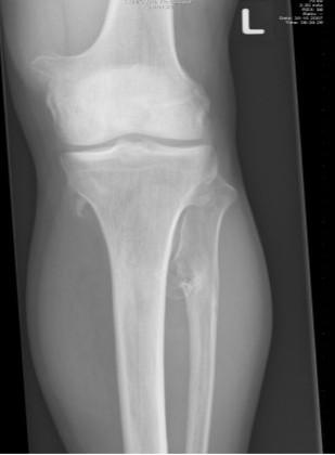 Множествени остеохондроми около коляното при HME