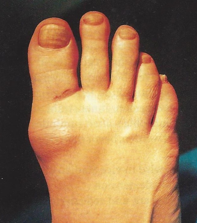 Hallux rigidus