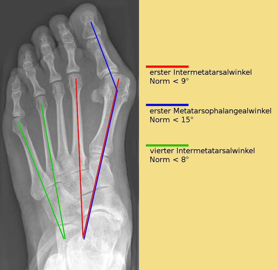 Hallux valgus с нормативни ъгли