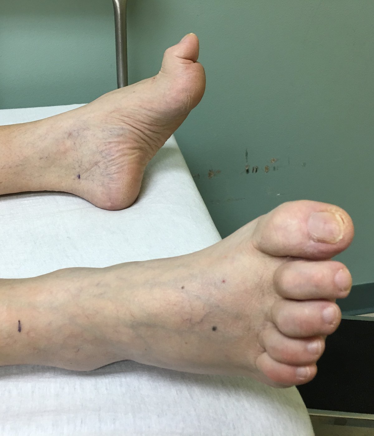 Чукообразни пръсти (hammer toes)
