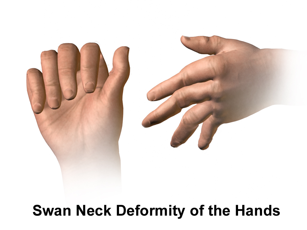 Swan-neck деформация при РА