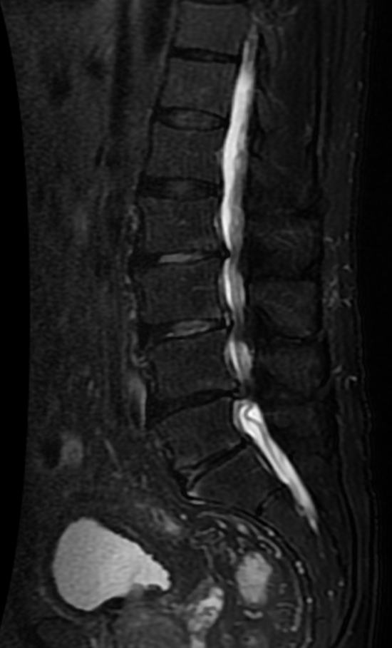 Лумбална спинална стеноза на MRI