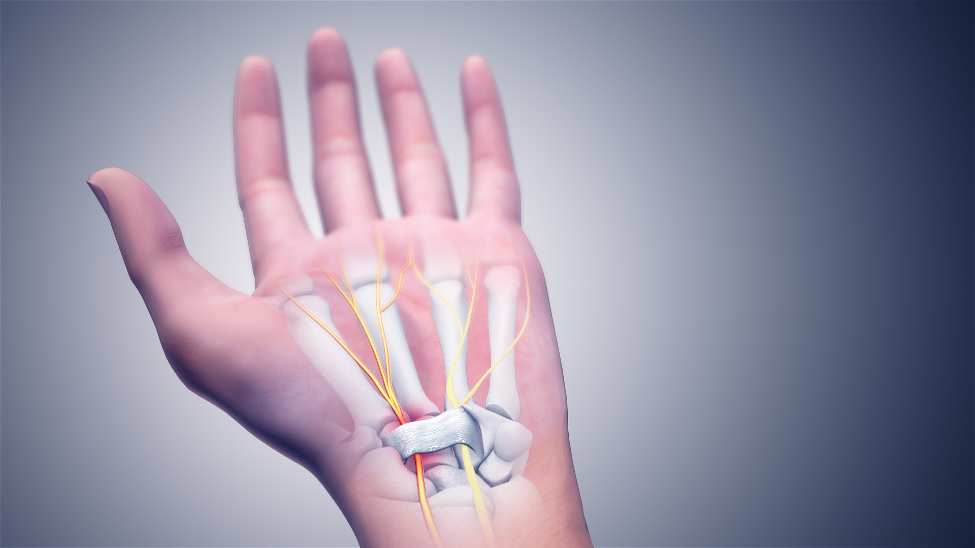 Синдром на carpal tunnel