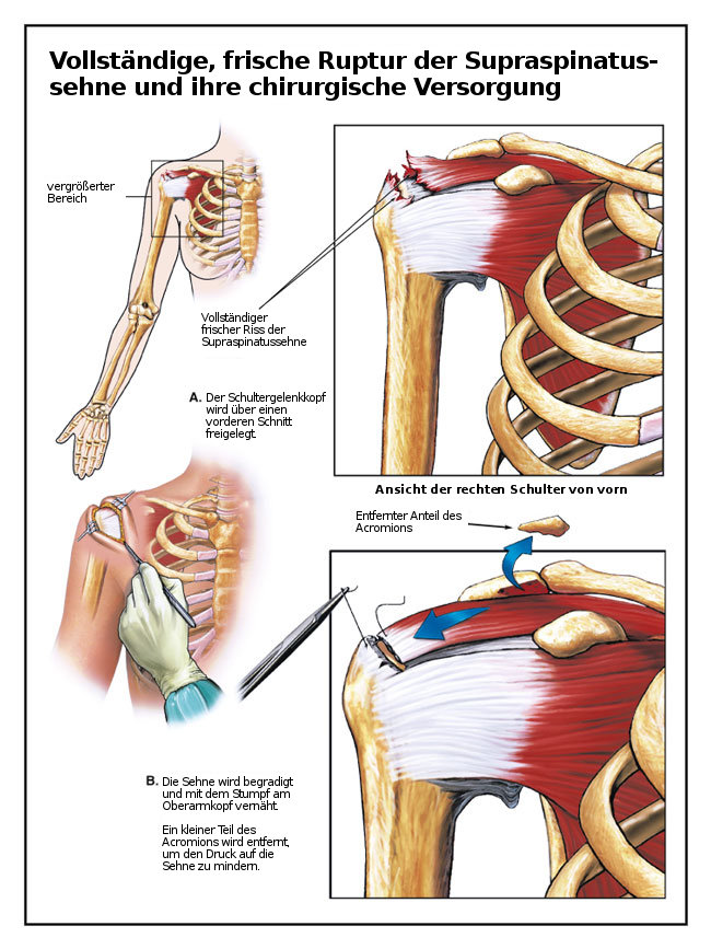 Разкъсване на сухожилието на m. supraspinatus