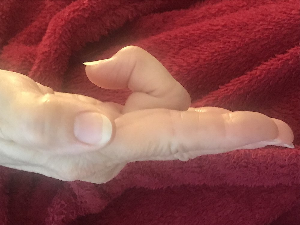 Trigger finger