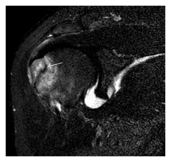 Окултна фрактура на tuberculum majus на MRI
