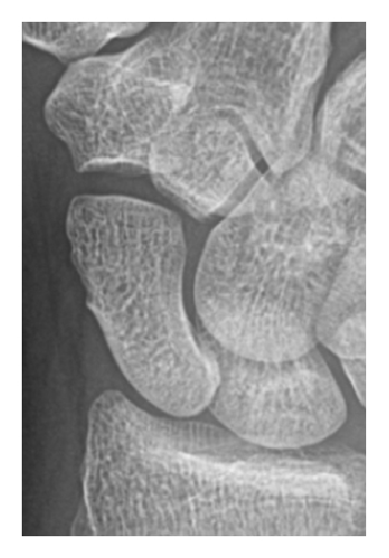 Окултна фрактура на scaphoid