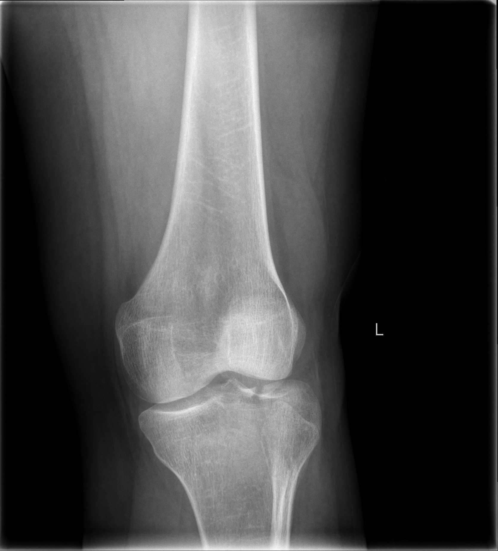 Фрактура на латералния тибиален плато