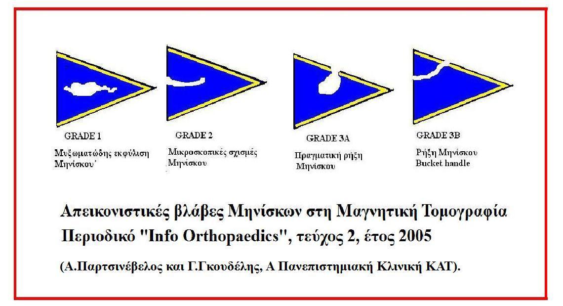 Разкъсване на менискус на MRI