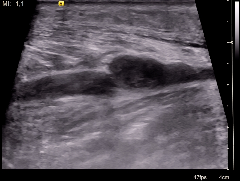 Разтягане на m. gastrocnemius (medial)