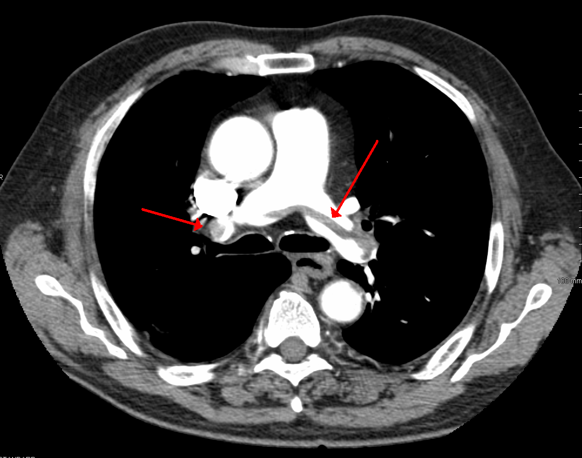 Saddle pulmonary embolism